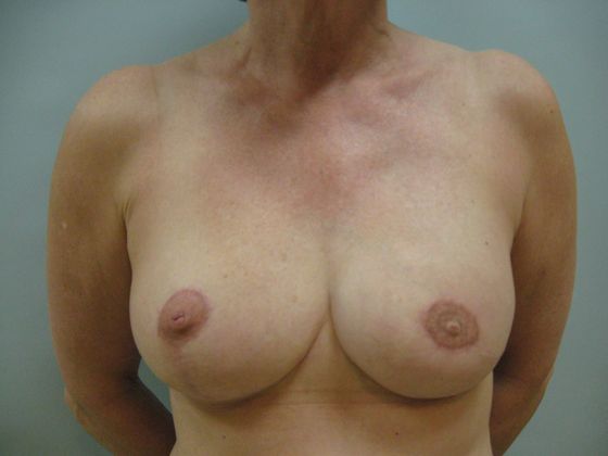 Breast reconstruction Before & After