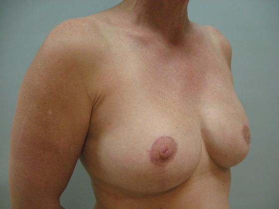 Breast reconstruction Before & After