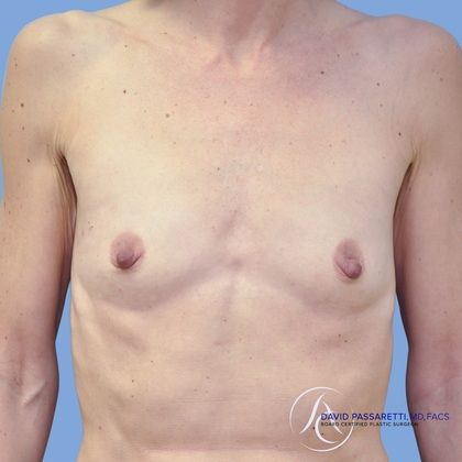 Breast reconstruction Before & After