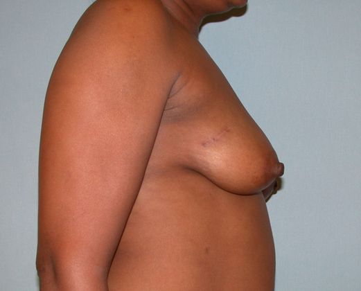 Breast reconstruction Before & After