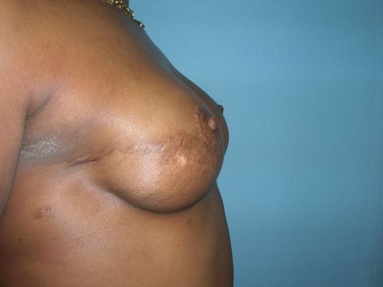 Breast reconstruction Before & After