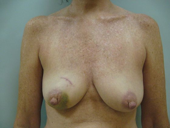 Breast reconstruction Before & After