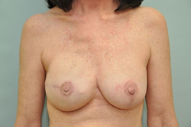 Breast reconstruction Before & After