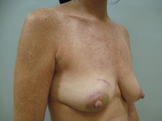 Breast reconstruction Before & After