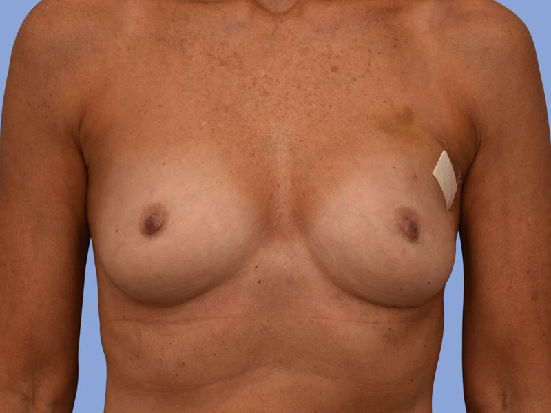 Breast reconstruction Before & After