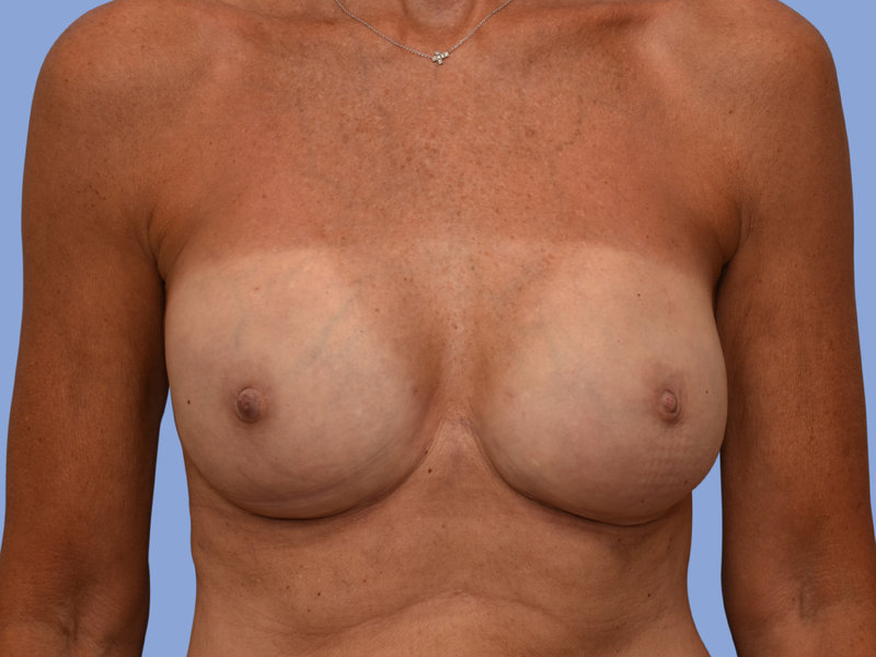 Breast reconstruction Before & After
