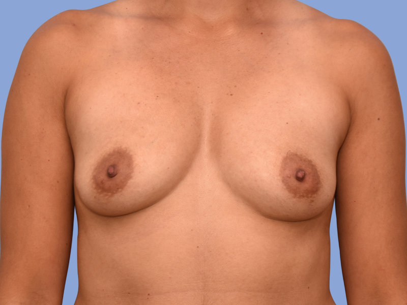 Breast reconstruction Before & After