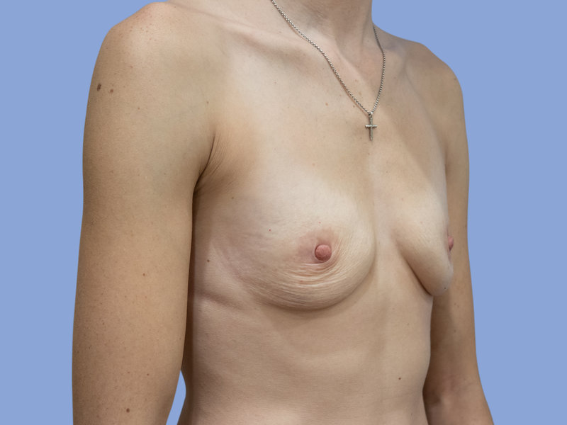Breast reconstruction Before & After