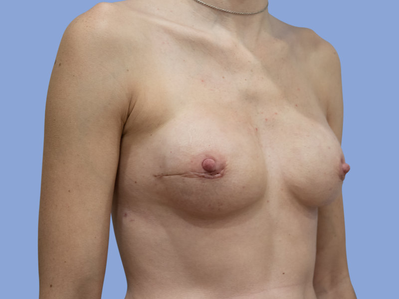 Breast reconstruction Before & After