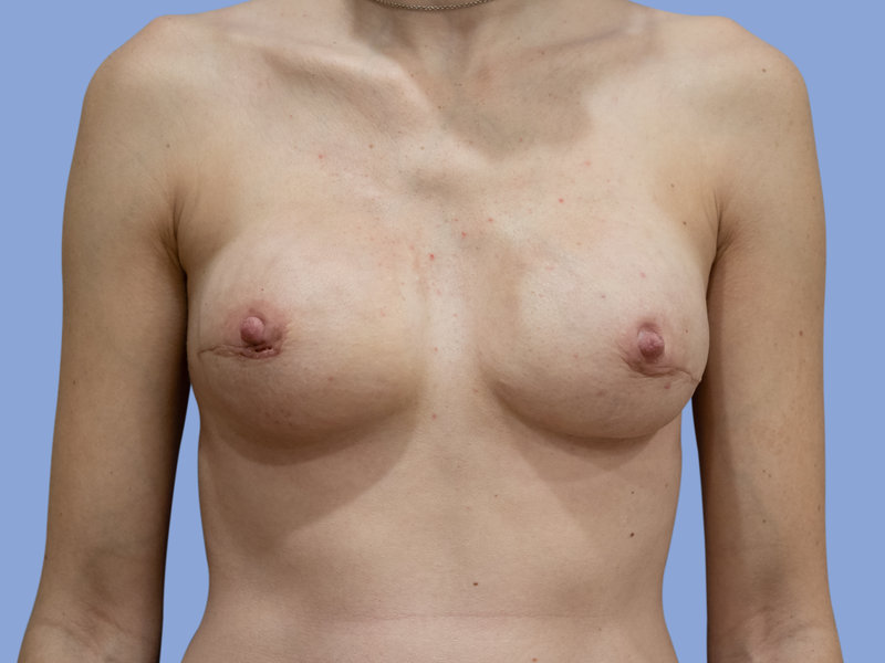 Breast reconstruction Before & After
