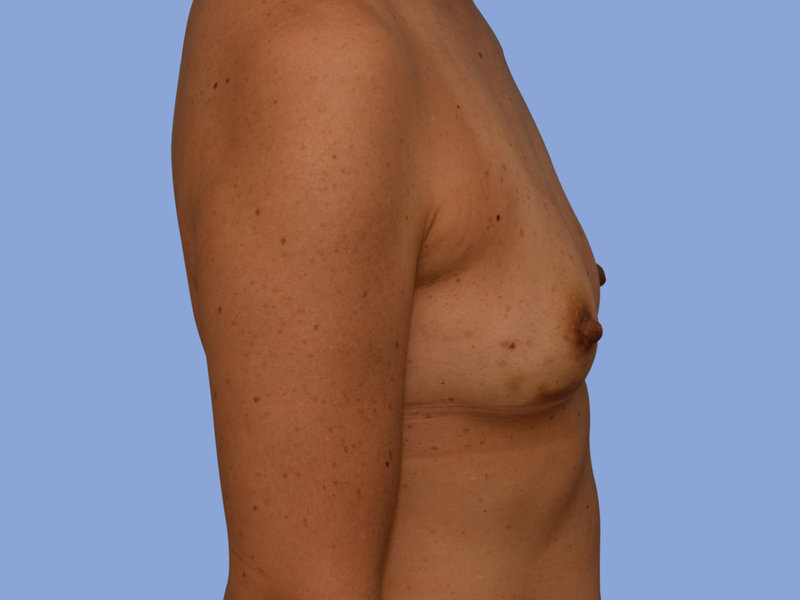 Breast reconstruction Before & After