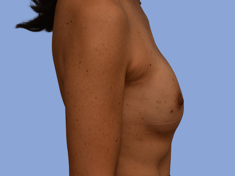 Breast reconstruction Before & After