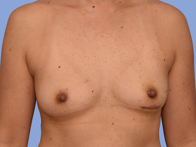 Breast reconstruction Before & After