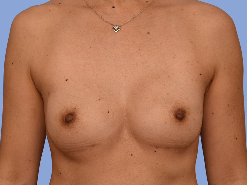 Breast reconstruction Before & After
