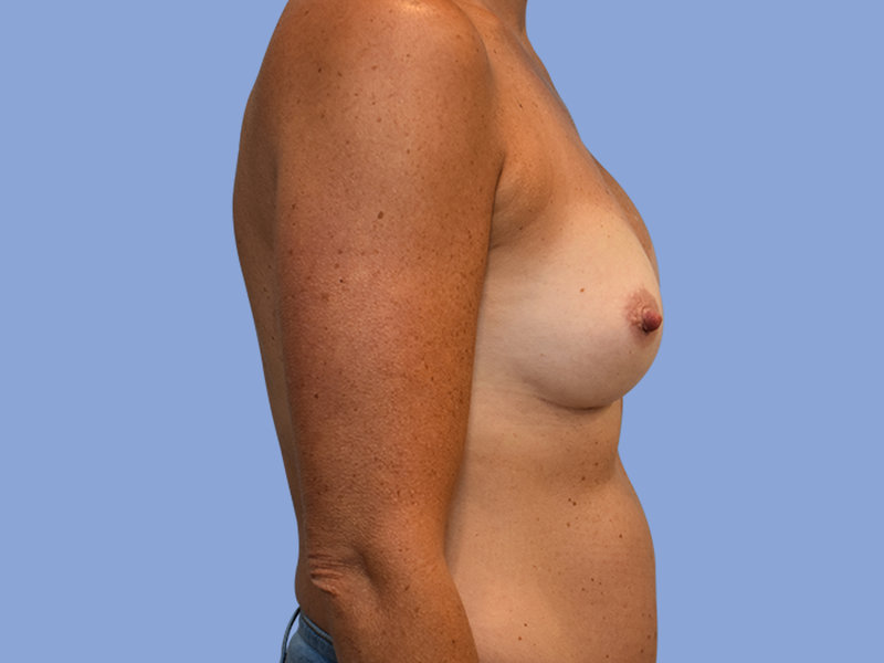Breast reconstruction Before & After