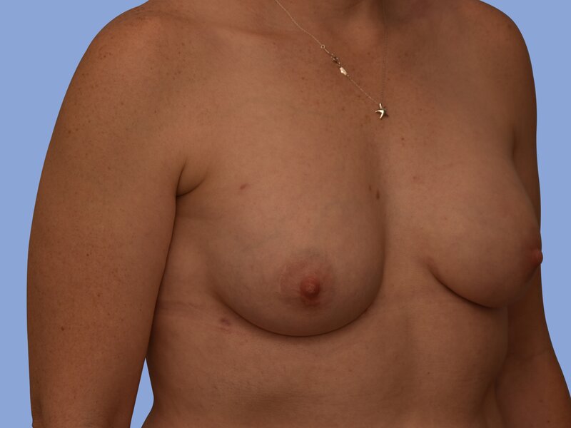 Breast reconstruction Before & After