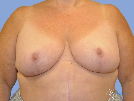 Breast reduction Before & After