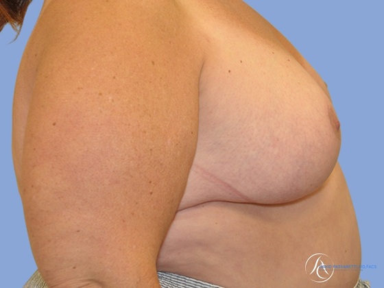 Breast reduction Before & After