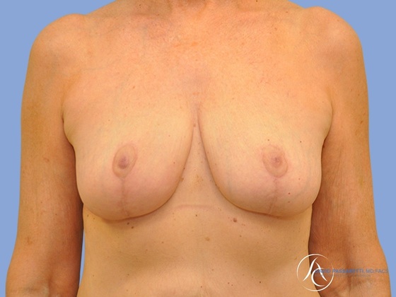 Breast reduction Before & After