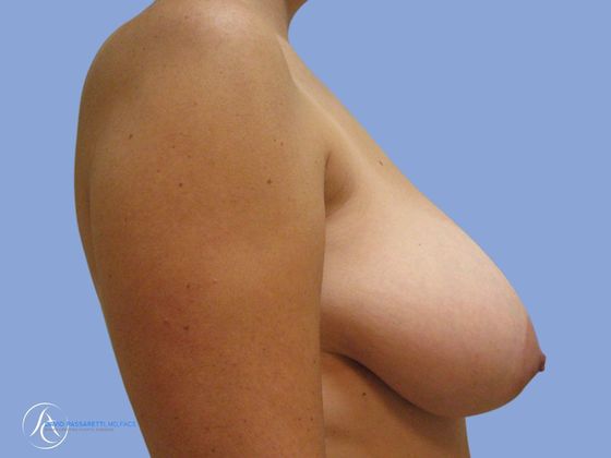 Breast reduction Before & After