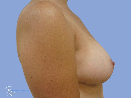 Breast reduction Before & After