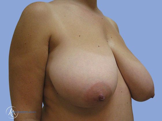 Breast reduction Before & After