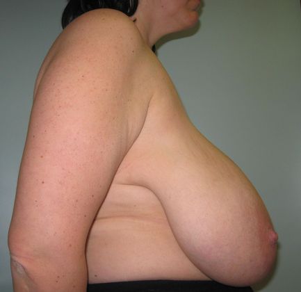 Breast reduction Before & After