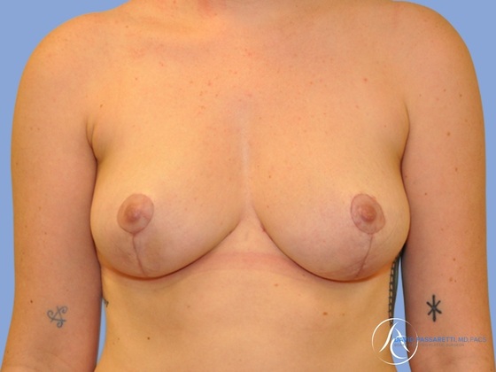 Breast reduction Before & After