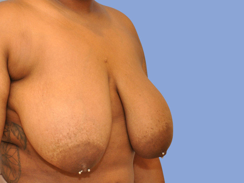Breast reduction Before & After