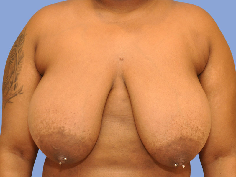 Breast reduction Before & After