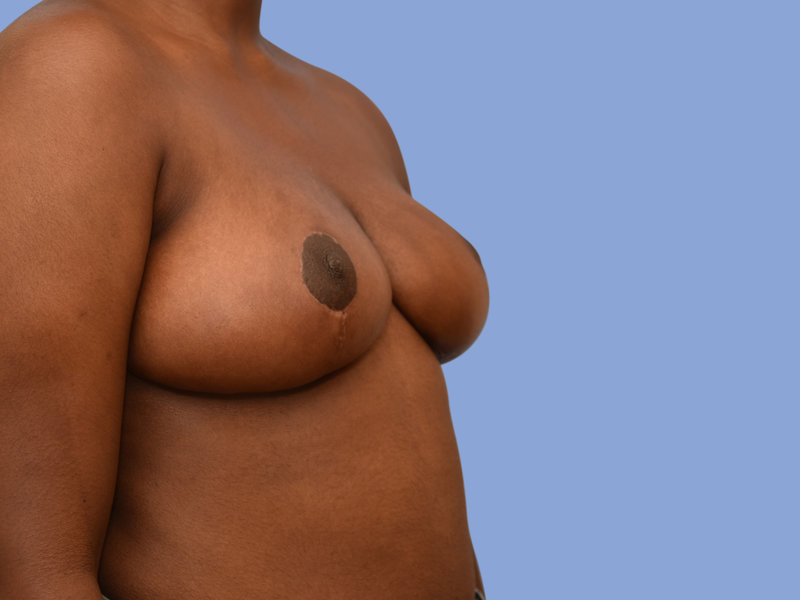 Breast reduction Before & After