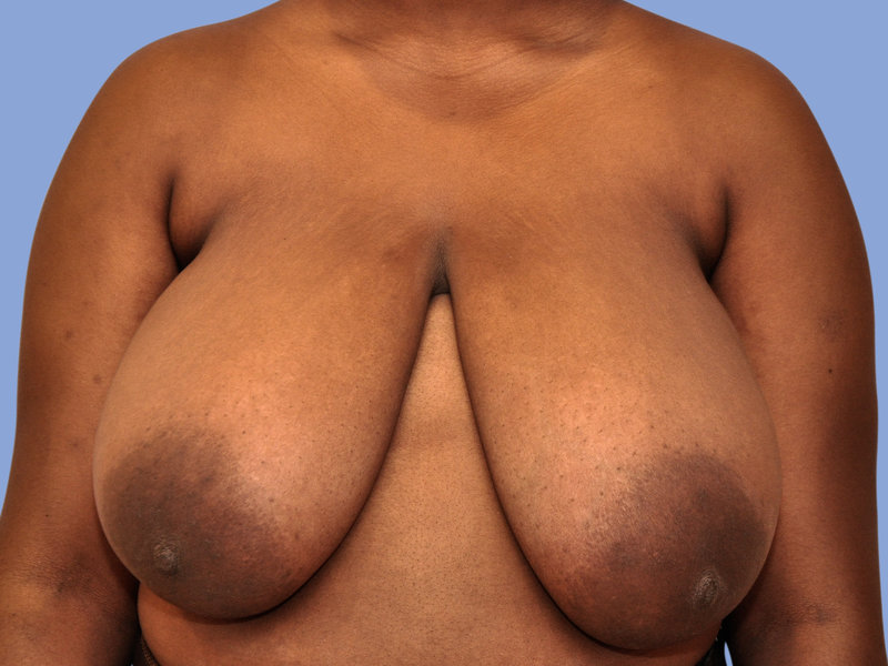 Breast reduction Before & After