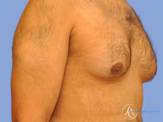 Male breast reduction Before & After