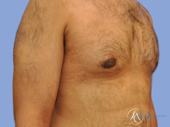 Male breast reduction Before & After