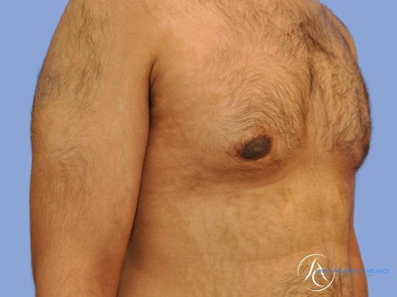 Male breast reduction Before & After