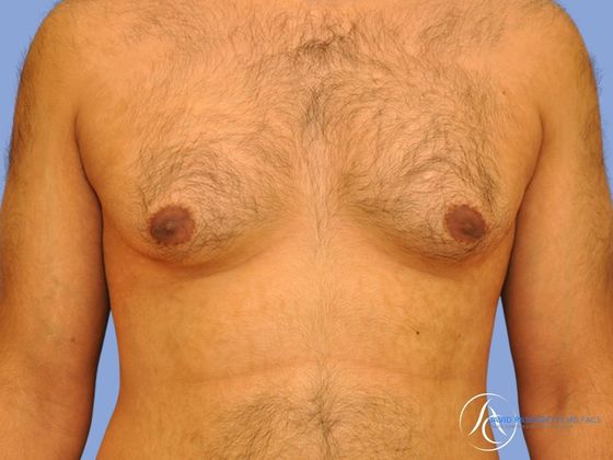 Male breast reduction Before & After