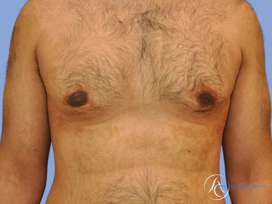 Male breast reduction Before & After