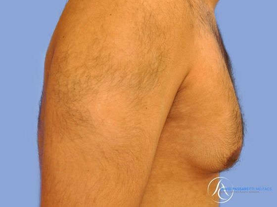 Male breast reduction Before & After