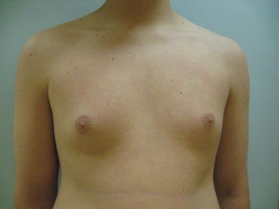 Male breast reduction Before & After