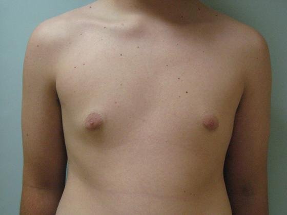 Male breast reduction Before & After