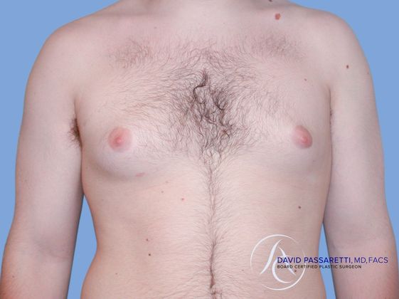 Male breast reduction Before & After