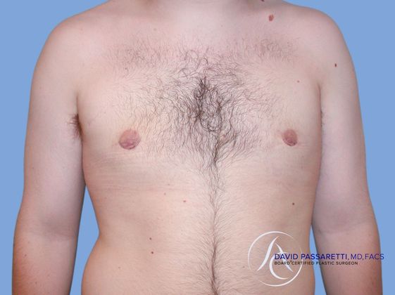 Male breast reduction Before & After