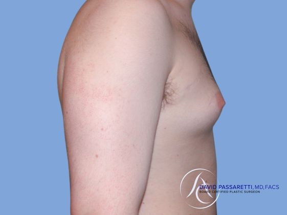 Male breast reduction Before & After