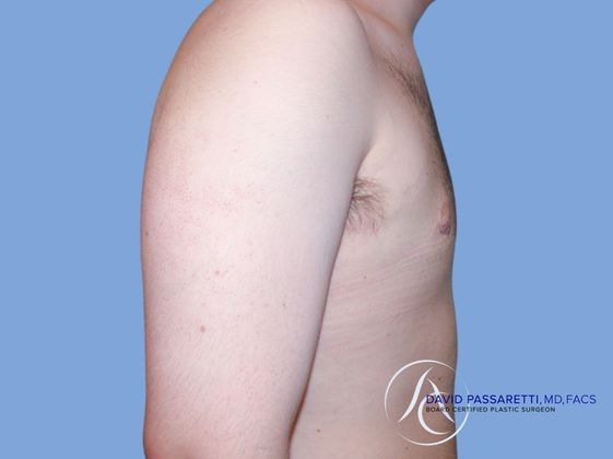 Male breast reduction Before & After