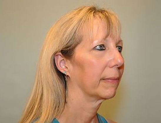 Chin augmentation Before & After