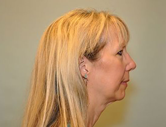 Chin augmentation Before & After