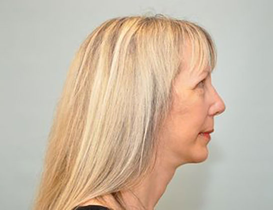 Chin augmentation Before & After