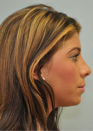Ethnic rhinoplasty Before & After