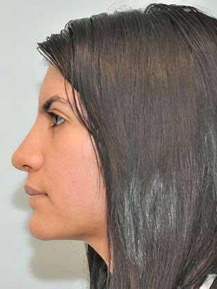 Ethnic rhinoplasty Before & After