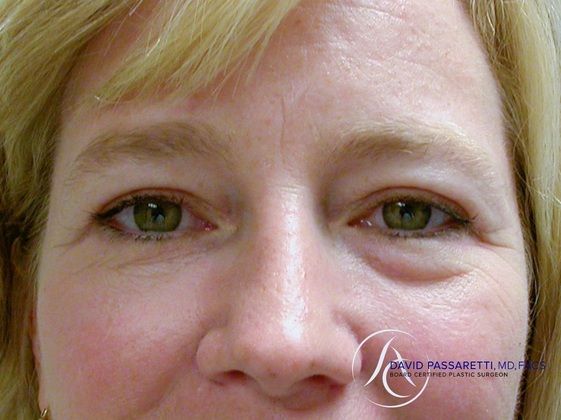 Eyelid surgery Before & After